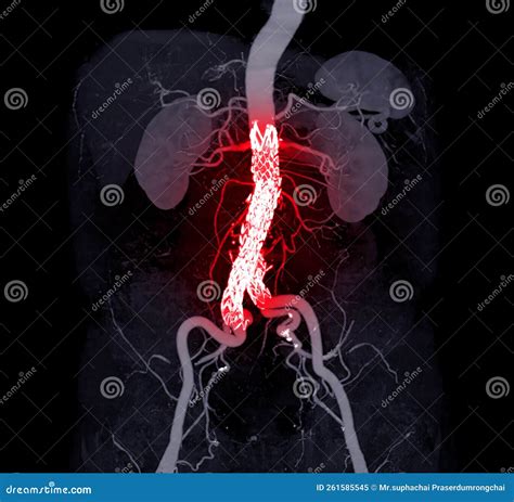 CTA Whole Aorta with Abdominal Aorta Stent Graft Compare 3D Rendering Image Stock Illustration ...