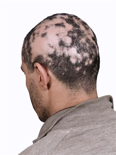 Is Your Hair Loss Normal or a Case of Alopecia? - The Pretty Pimple