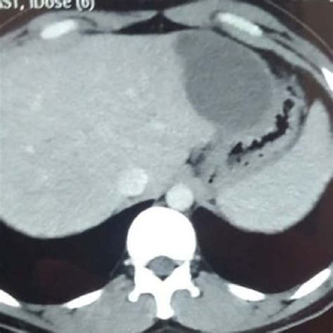 -Computed tomography showing hypodense lesion in left lobe of liver ...