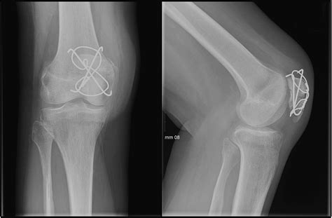 A Modified Tension Band Fixation Technique for the Management of Patellar Fractures Using ...