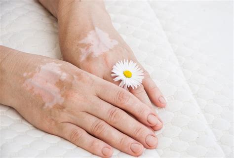 7 Home Remedies to Prevent & Reduce Vitiligo - eMediHealth