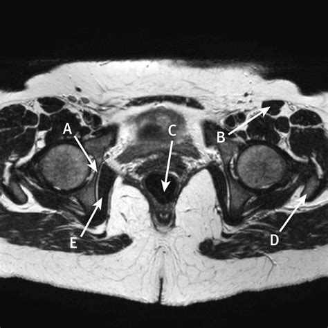 Sumergido Doctrina Alcalde mri female pelvis anatomy Frente Casco Madurar