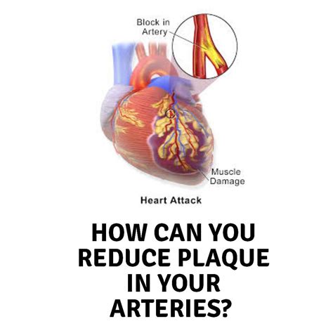 How can you reduce plaque in your arteries? in 2020 | Arteries, How to increase energy, Clogged ...