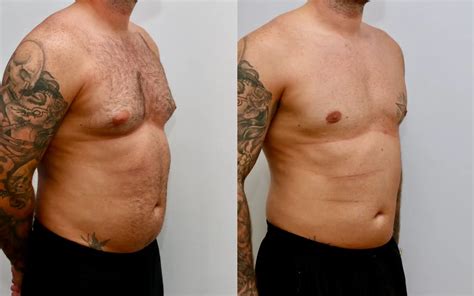 #1 Gynecomastia Surgery Scotland | Boost Confidence Now