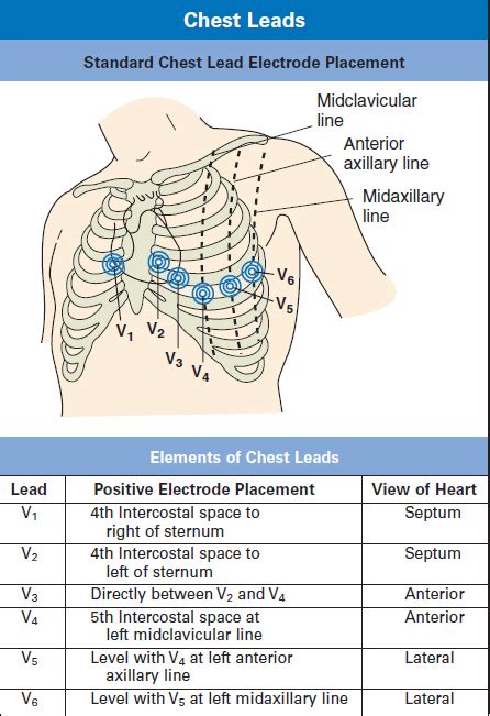 Printable Ecg Placement Diagram