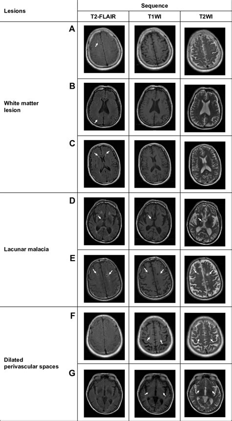 examples of the characteristic changes shown on T2-FlAIr in comparison... | Download Scientific ...