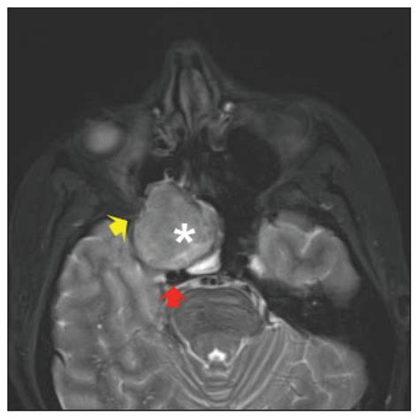 Vidian Nerve Schwannoma: A Rare Skull-Base Neoplasm Presenting with Ocular Manifestations: A ...