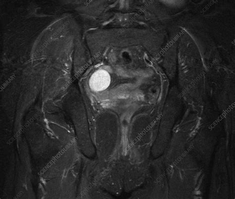 Ovarian Cyst Mri