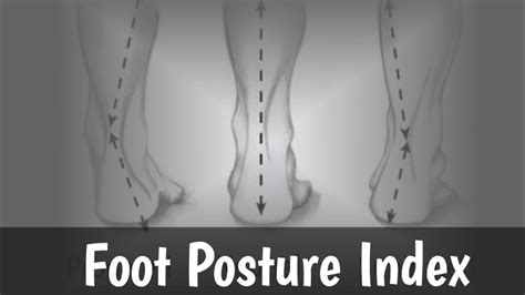 Foot Posture Index | FPI | Foot Posture Assessment | - YouTube