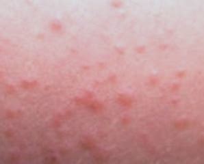 Lamictal Rash - Pictures, Symptoms, Treatment | Health Momma