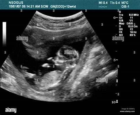 Ultrasound image of a baby in the womb sucking its thumb with the other hand behind its head. A ...