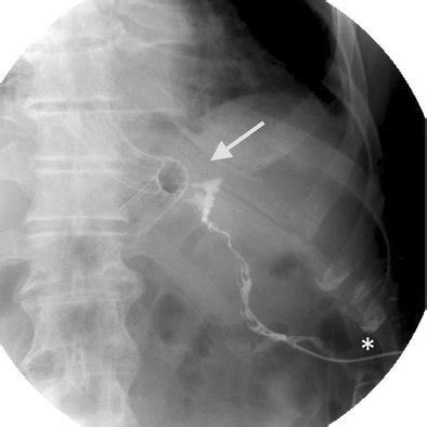 Fistulography showing a fistula from the stomach to the skin (arrow) | Download Scientific Diagram