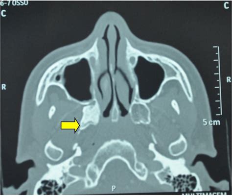 Axial section of computed tomography showing involvement of the right... | Download Scientific ...