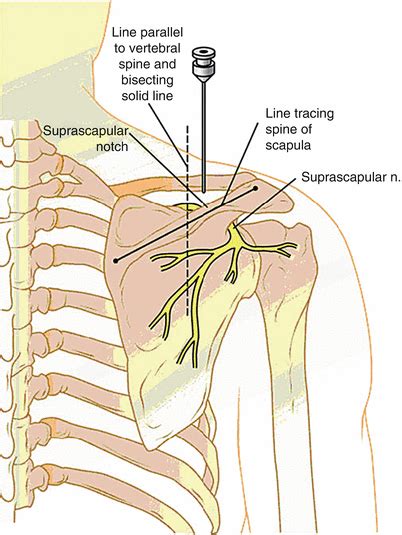 Suprascapular Nerve Block | Radiology Key