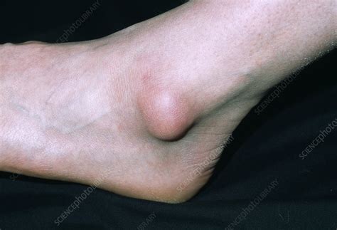 Bursa on ankle - Stock Image M120/0127 - Science Photo Library