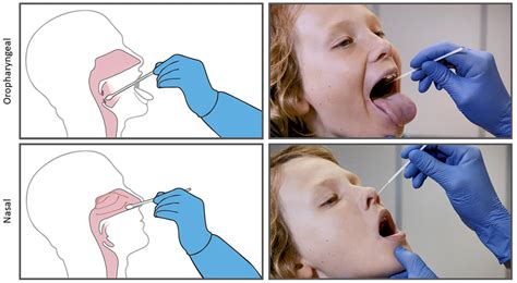 | Combined oropharyngeal and nasal (OP/Na) swabbing with a single fine... | Download Scientific ...