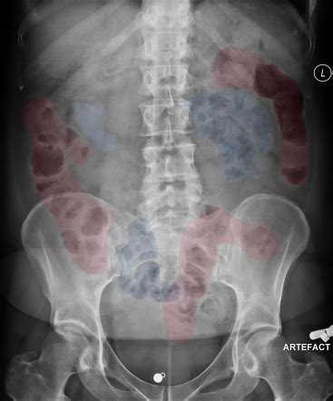 Bowel dilatation (summary) | Radiology Reference Article | Radiopaedia.org