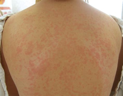 👉 Maculopapular Rash - Pictures, Causes, Treatment, Diagnosis (January ...