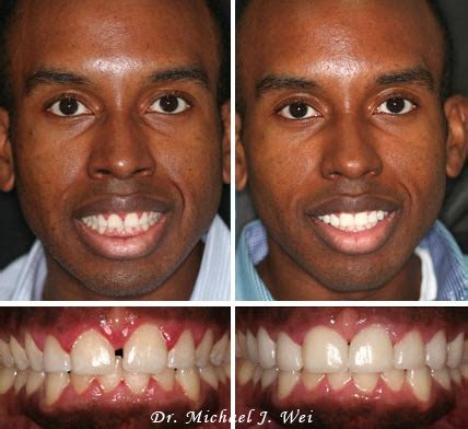 Teeth Veneers Before And After