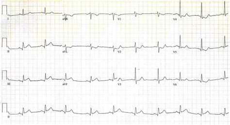 What Happens In Sinus Arrhythmia - BEST HOME DESIGN IDEAS