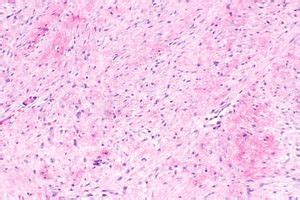 Desmoid-type fibromatosis - Libre Pathology