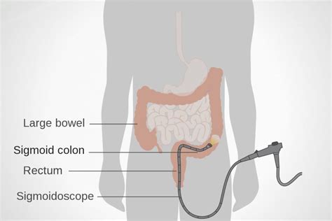 Sigmoidoscopy – NuLife Hospital – Gastroenterology, Liver Diseases & Endoscopy in Mohali