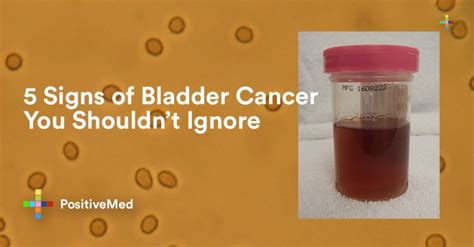 5 Signs of Bladder Cancer You Shouldn't Ignore - PositiveMed