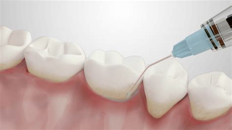 Oraqix Dispenser & Periodontal Gel | Dentsply Sirona USA