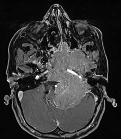 This skull base meningioma completely eroded the skull base and encased ...