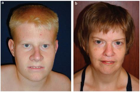 Prader Willi Syndrome - Symptoms, Causes, Complications, Pictures ...