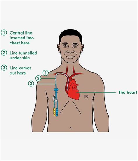 Hickman line, PICC line insertion for Bone – Dr. Kushan Nanavati – Vascular & Endovascular ...