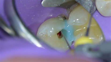 Root Canal Procedure Technique (Premolar) w/ Gentle Wave - YouTube