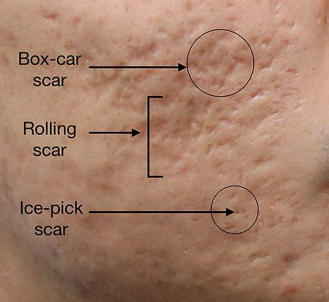 Acne Scars - The Treatment Options