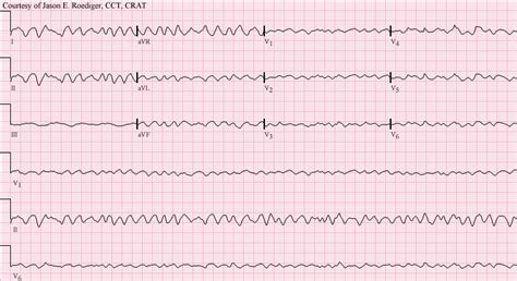 V-fib | ECG Guru - Instructor Resources