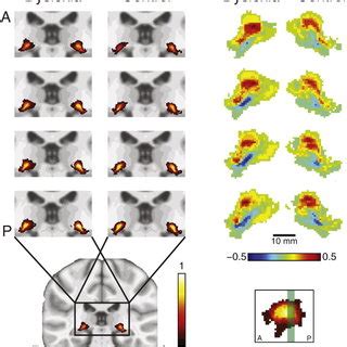 Probability maps of the LGN anatomy in native space. Each row shows a ...