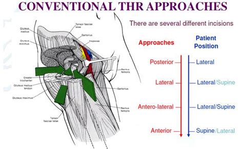 Prof Lawrence Kohan - Direct Anterior Approach