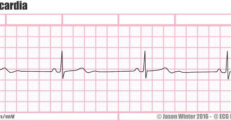 ECG Educator Blog : Sinus Bradycardia