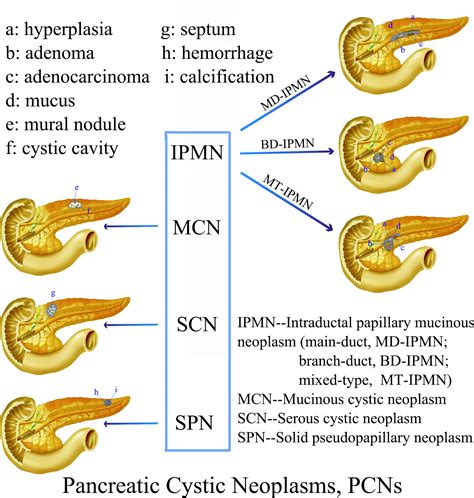 Frontiers | Cystic Neoplasms of the Pancreas: Differential Diagnosis ...