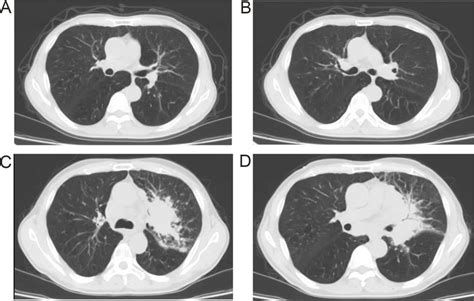 A and B show the CT scan results 2 months after treatment. C and D show ...