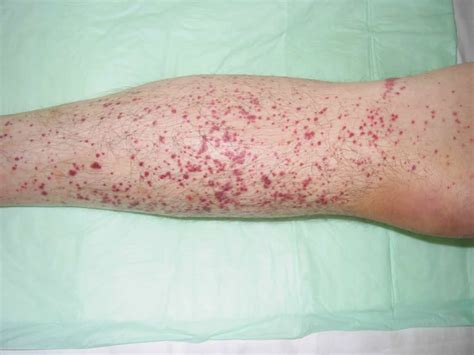 Petechiae Causes Treatments Pictures And More