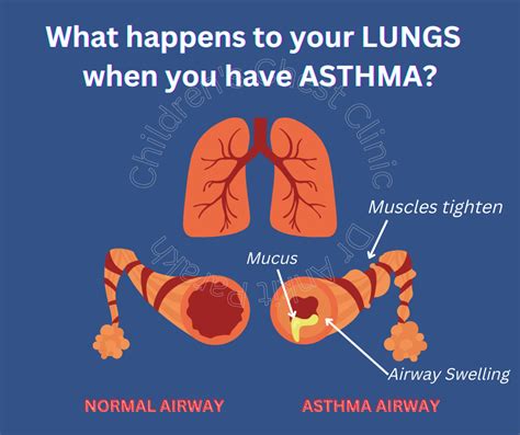 What happens to your lungs when you have Asthma? - Dr. Ankit Parakh