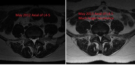 Recurrent Herniated Nucleus Pulposus - Shim Spine