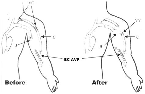 Basilic vein (B) transposition VV for long segment proximal VO of an... | Download Scientific ...