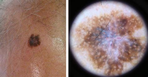 Melanoma on scalp pictures: early stage 1, scalp melanoma images ...