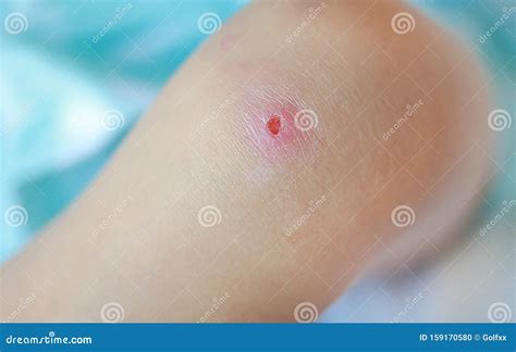 A Lesions of the kid knee stock photo. Image of accident - 159170580