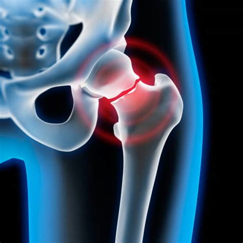 Femoral neck fractures | Joint-surgeon.com