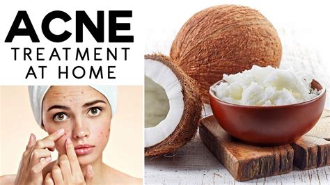 Acne Treatment with Coconut Oil | Best Acne Remedy at Home | Ayurveda - YouTube