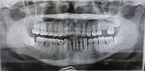 Localized Aggressive Periodontitis - THE TRUE LIFE OF A DENTAL STUDENT ...