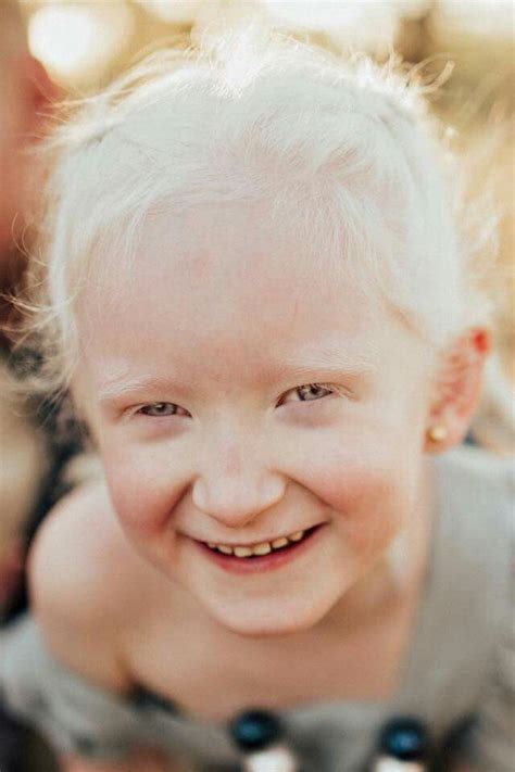 white hair white eyelashes child albino albinism red eyes pale skin not ...