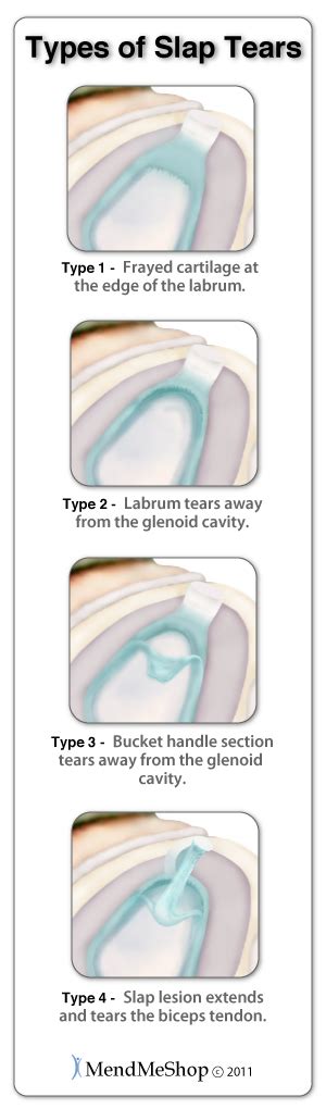 SLAP (Superior Labrum Anterior to Posterior) Tear